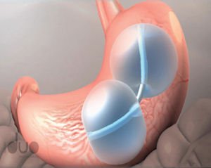 ReShape Duo: device is inflated, as shown in image at right, after being placed in stomach